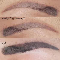 پاک کردن و ریموو تاتو صورت بدون عوارض و در یک جلسه|خدمات آرایشگری و زیبایی|تهران, دهکده المپیک|دیوار