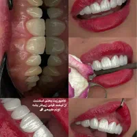 کامپوزیت تخصصی فقط از فکی ۳.۵ اقساطی
