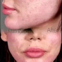 مرکز تخصصی ژل و بوتاکس در قزوین|خدمات آرایشگری و زیبایی|قزوین, |دیوار