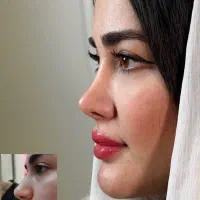 عمل بینی زیبایی بینی