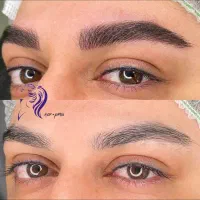 میکروبلیدینگ و فیبروز روی تتو های قدیمی