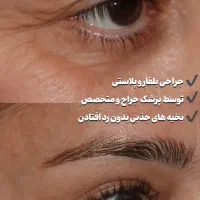 بلفاروپلاستی تخفیف ویژه ساکشن غبغب سوپرکانتورینگ|خدمات آرایشگری و زیبایی|اهواز, کیان اباد|دیوار