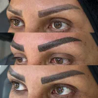 فیبروز و میکروبلیدینگ