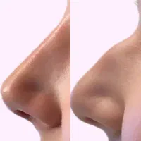 اصلاح فرم بینی باتزریق فیلربدون جراحی باقیمت عالی|خدمات آرایشگری و زیبایی|اصفهان, وحید|دیوار