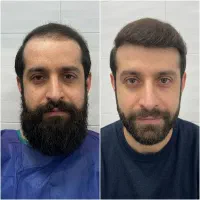 کاشت مو اقساطی