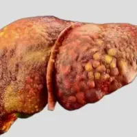 مرگ خاموش یعنی کبدچرب از این آگهی راحت رد نشو