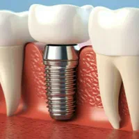ایمپلنت کره‌ای قیمت مناسب/فرصت طلایی/ضمانت/کیفیت|خدمات آرایشگری و زیبایی|رشت, گلسار|دیوار