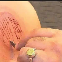 آموزش  حجامت