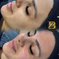 لیزر موهای زائد پی‌آر‌پی هایفو حجم‌سینه‌باسن لاغری|خدمات آرایشگری و زیبایی|تهران, صادقیه|دیوار
