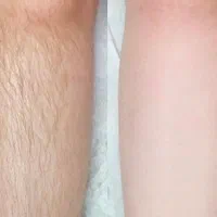 کلینیک لیزر موهای زائد|خدمات آرایشگری و زیبایی|خمینیشهر, |دیوار