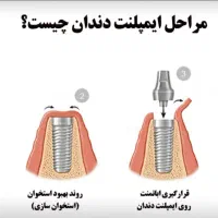 ایمپیلنت تخصصی کلینیک دندانپزشکی آرمی|خدمات آرایشگری و زیبایی|تهران, شکوفه (عبدل آباد)|دیوار