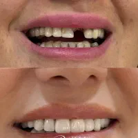 دندانپزشکی/کامپوزیت دیجیتال/ ایمپلنت/عصب کشی|خدمات آرایشگری و زیبایی|مشهد, ده دی|دیوار