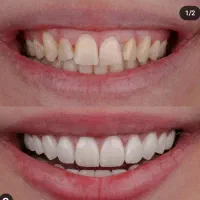 جشنواره کامپوزیت لمینت ، روکش