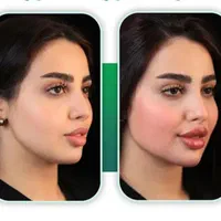 ژل و بوتاکس|خدمات آرایشگری و زیبایی|جیرفت, |دیوار