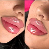 بوتاکس وژل ونخ وچالگونه مزوانزیم فیلرفیبروز شیدینگ