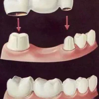 روکش بریج(پل) دندانپزشکی