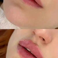 تخفیف ژل لب و بوتاکس فیلر مزو دکتر کاظمی|خدمات آرایشگری و زیبایی|مشهد, کوثر|دیوار