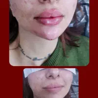 ژل بوتاکس خالبرداری|خدمات آرایشگری و زیبایی|زابل, |دیوار