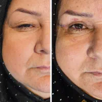 تخفیف بلفارو رفع افتادگی پلک بالا با بخیه لیزری