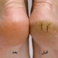 کرم ترک پا|آرایشی، بهداشتی، درمانی|سنندج, |دیوار