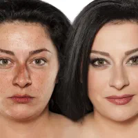 خال صورت/لکه های پوستی/لیزرموسفید/ریموتتو/بوتاکس|خدمات آرایشگری و زیبایی|نجف‌آباد, بازار|دیوار