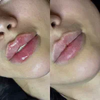 لیزر‌موزائد،ژل بوتاکس مزو،ریمو تتو،هایفو فیشال|خدمات آرایشگری و زیبایی|تهران, جیحون|دیوار