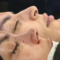 جراحی بینی به روش مدرن (SEG)