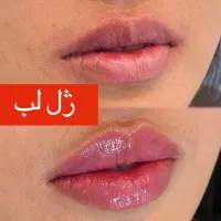 مطب ژل و بوتاکس ژل لب گرگان