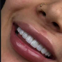کامپوزیت،لمینت،روکشطلا،اقساطی|خدمات زیبایی و سلامت|تهران, جردن|دیوار