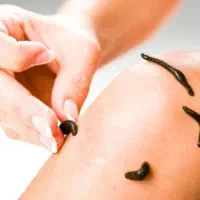 زالو درمانی و حجامت درطب سنتی با ۸ سال سابقه کار