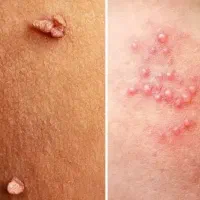 اینجا تضمینی درمان میشی/ زگیل و HPV