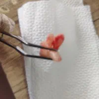 کشیدن دندان خوی تا سلماس