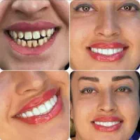 تخفیف خدمات کامپوزیت|خدمات آرایشگری و زیبایی|اهواز, زیتون کارمندی|دیوار