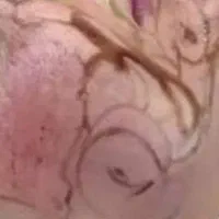 زیبایی پوست تخلیه لک با متد پکینگ آپ در مطب