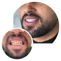 کامپوزیت دندان و اموزش