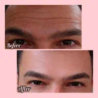 ژل بوتاکس|خدمات آرایشگری و زیبایی|سبزوار, امیر کبیر|دیوار