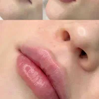 انجام تخصصی فیلروبوتاکس وتتو