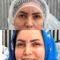 جراحی پلک با بخیه لیزری توسط جراح متخصص زیبایی|خدمات آرایشگری و زیبایی|تهران, تجریش|دیوار