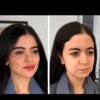 تخفیف  استثنایی و باورنکردنی ژل وبوتاکس