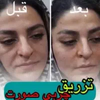 ژل بوتاکس فیلر لاغری هایفو خال لیزر پی ار پی ساکشن