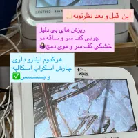 درمان قطعی شوره ،چربی،و انواع ریزش های مو