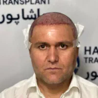 کاشت مو‌روش sut