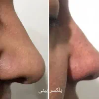 مزونیدلینگ کل صورت و پاکسازی وخالبرداری وآموزش|خدمات آرایشگری و زیبایی|یزد, |دیوار
