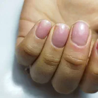 کاشت ژلیش لمینیت