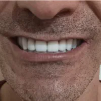 دندانسازی باکیفیت عالی، قیمت مناسب خیابان گرگان|خدمات آرایشگری و زیبایی|تهران, گرگان|دیوار