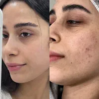 پاکسازی صورت و جوان سازی پوست بانوان