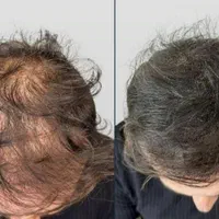 اسکالپ تخصصی در کلینیک پوست مو کاشت میکرو اسکالپ