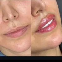 ژل اودری اصل سی سی 350بوتاکس ۵۰۰و خال برداری|خدمات آرایشگری و زیبایی|قم, زنبیل آباد|دیوار