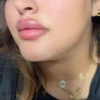 تزریق ژل ،فیلر بوتاکس مزو آنزیم خال برداری|خدمات آرایشگری و زیبایی|الیگودرز, |دیوار