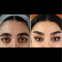 جشنواره تخفیف جراحی زیبایی شقیقه،بلفارو،دایرکت